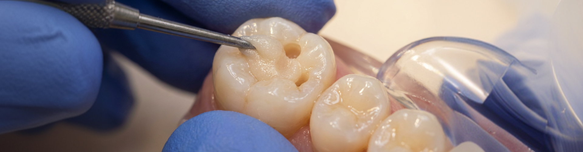 Dentist applying dental composite resin filling to a cavity during a tooth restoration procedure.